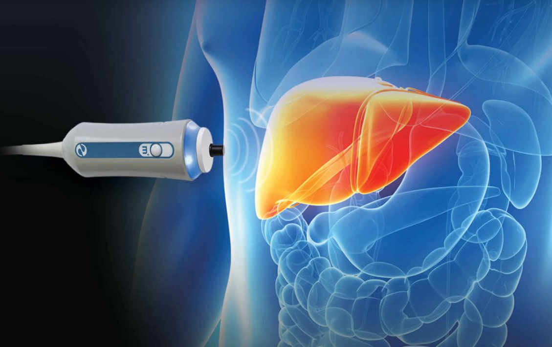 FIBROSCAN with CAP