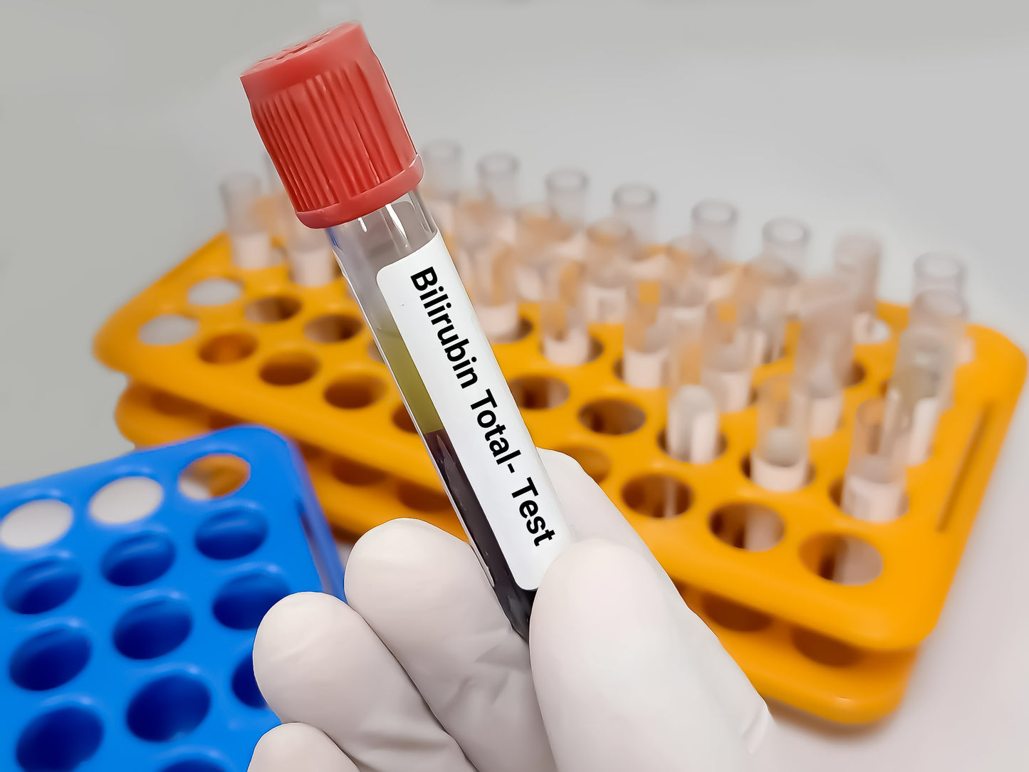 BILIRUBIN TOTAL